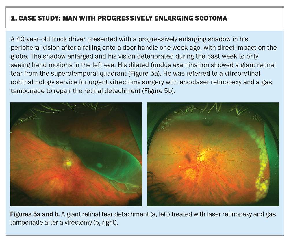 Flashes and floaters symptoms not to be ignored Medicine Today